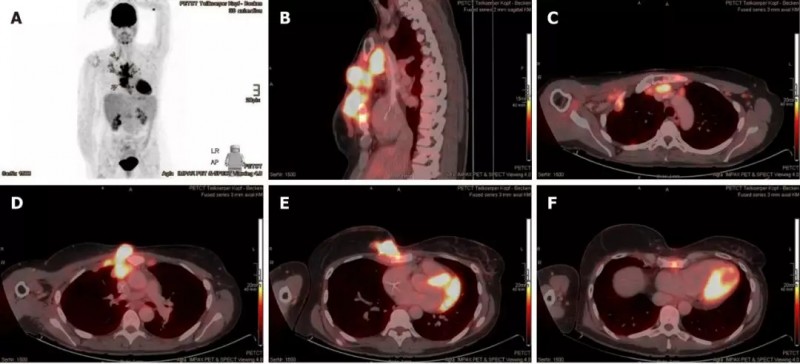 质子治疗乳腺癌,乳腺癌质子治疗效果,乳腺癌质子治疗优势