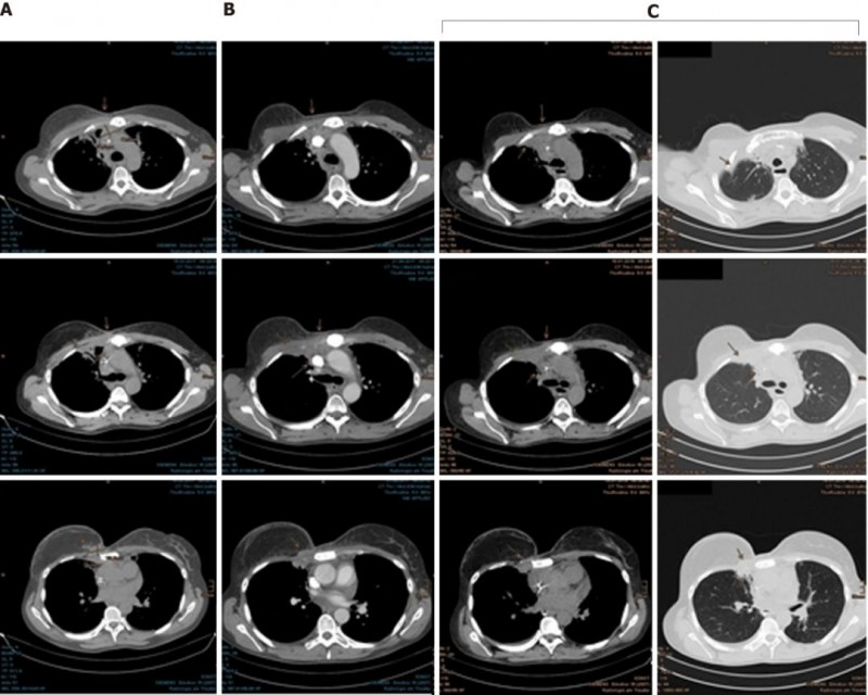 乳腺癌质子治疗效果非常好