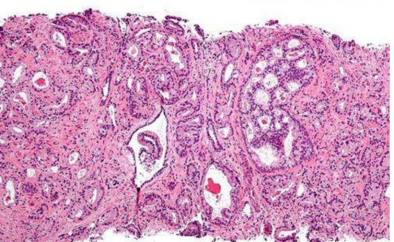 一种恶性前列腺癌急需新的治疗方法