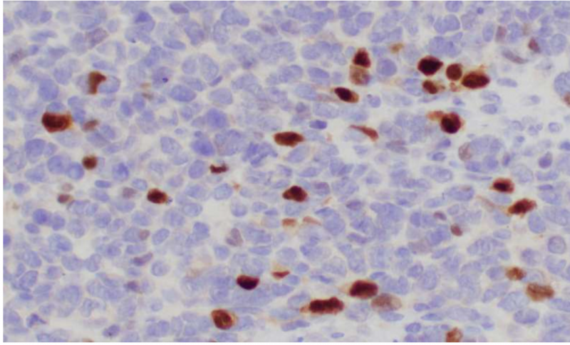 高科技：鉴别出儿童肿瘤的29种致癌基因