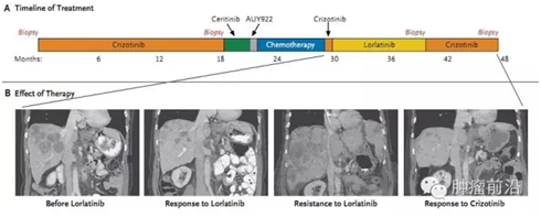 新英格兰：第3代ALK抑制剂的耐药突变L1198F对克唑替尼再次敏感