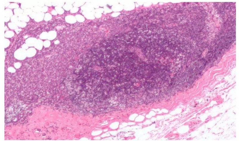 [抗癌突破]--重大发现：三阴乳腺癌治疗找到新靶点！新药物有望治疗与肥胖相关的乳腺癌和肺癌！