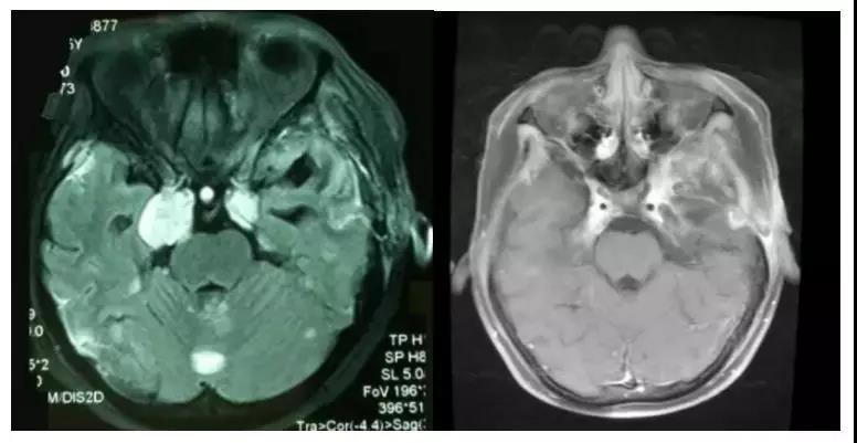奇迹|15岁女孩脑瘤质子治疗三个月后肿瘤消失