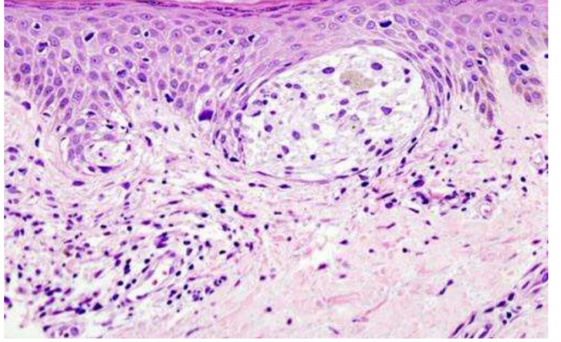 重磅结果！减肥手术能降低黑色素瘤风险