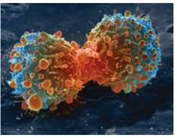 加拿大科学家发现脑瘤新靶点 司美替尼有治疗潜力