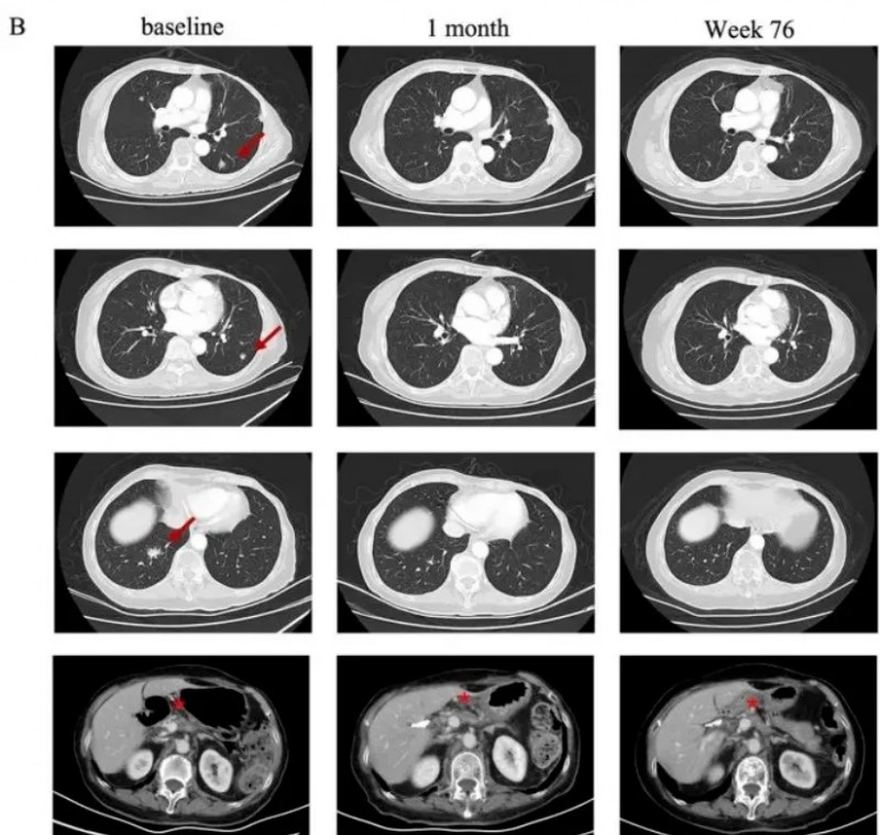 细胞免疫疗法治疗胰腺癌效果好吗,来看看这三个成功案例