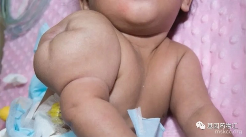 儿童肉瘤新药,肉瘤靶向药物新药拉罗替尼(Vitrakvi)帮助患者完成抗癌"奇迹"