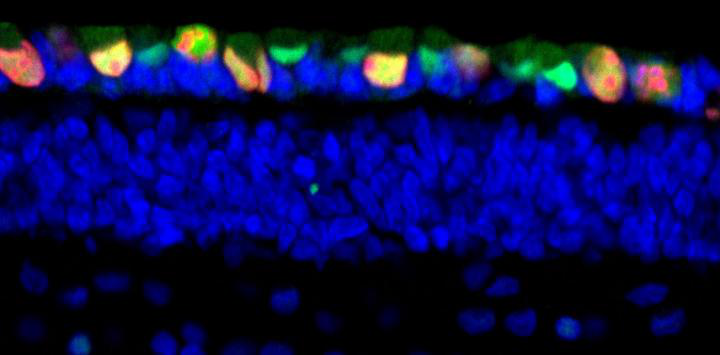 对儿童视网膜母细胞瘤实施干预不再遥不可及