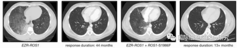 肺腺癌劳拉替尼治疗效果