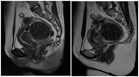 海扶刀手术帮子宫肌瘤患者轻松灭瘤