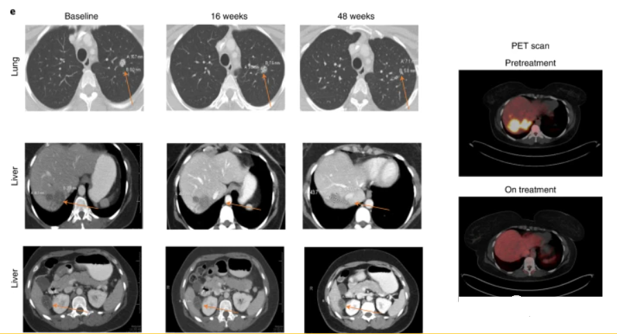 个体化mRNA肿瘤疫苗BNT122(Autogene Cevumeran)治疗结直肠癌患者48周后多处病灶持续缩小