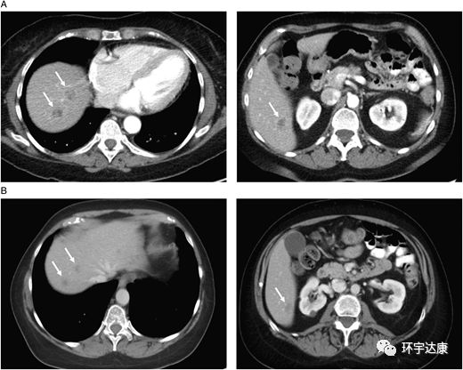 胰腺导管腺癌拉罗替尼治疗效果