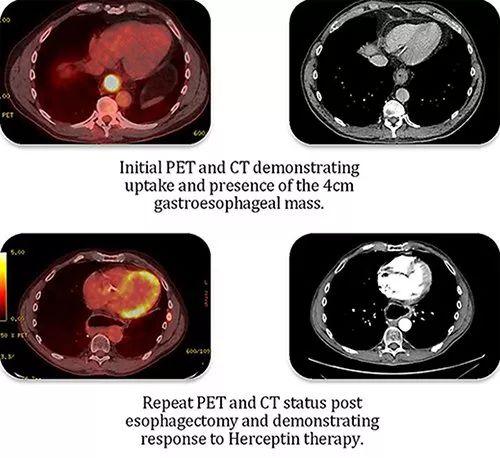 食管癌靶向药,食管癌有靶向药吗,治疗食管癌的靶向药,2019年食道癌靶向药靶向免疫治疗方案盘点