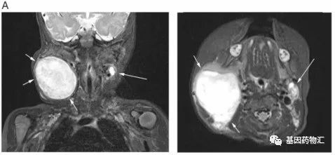 肉瘤治疗新进展,112天战胜致命肉瘤!化疗、靶向、放疗及癌症疫苗均有新进展,新药带来希望