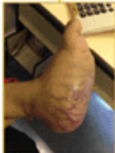 拉罗替尼治疗婴儿纤维肉瘤成功案例