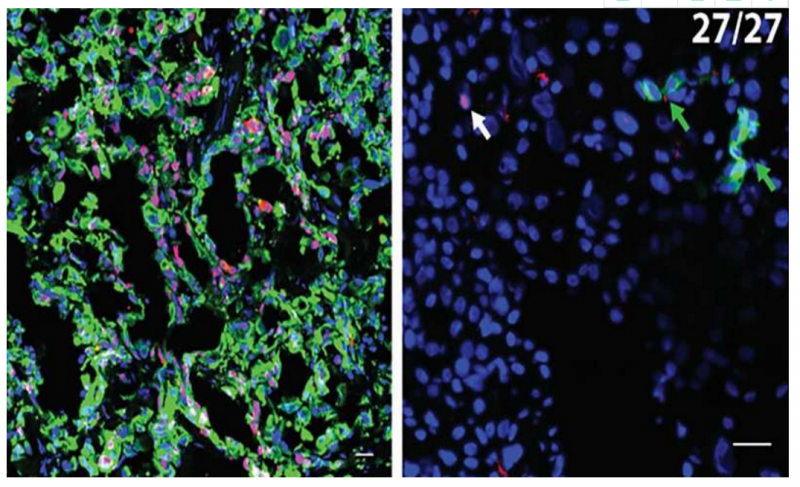 研究发现防止胰腺癌术后癌细胞转移的方法