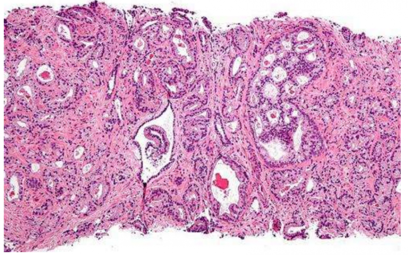 最新骨扫描软件能精准预测晚期前列腺癌的预后