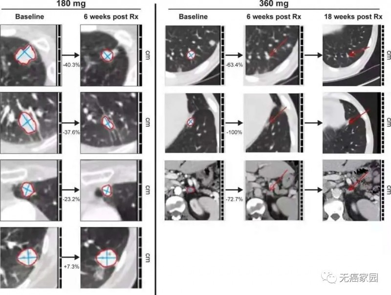 AMG-510治疗非小细胞肺癌前后对比