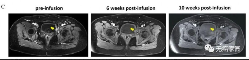 TIL疗法治疗复发性宫颈癌并伴有膀胱转移案例