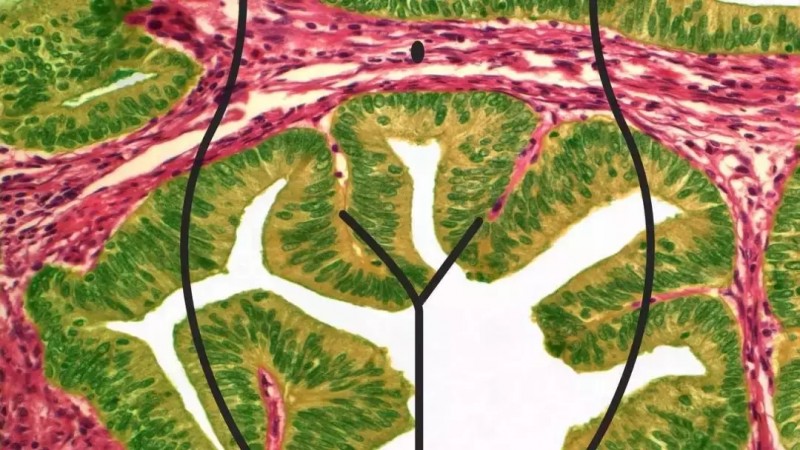 患(得)了子宫肌瘤怎么治疗,子宫癌怎么治疗比较好,子宫癌的治疗,子宫癌怎么治