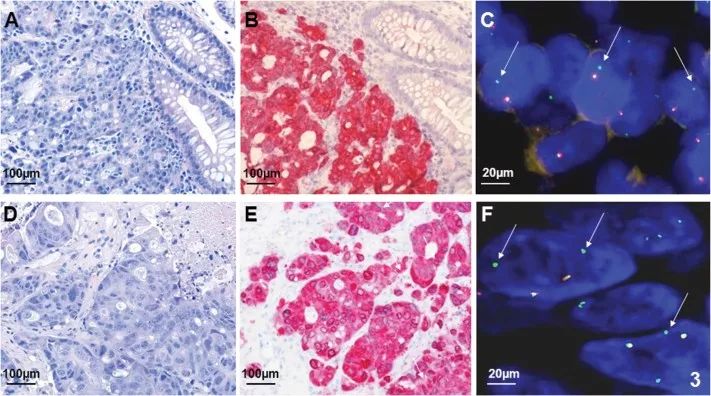 脑瘤放疗,脑胶质瘤放疗,速锋刀美国最新放疗技术无创清除脑胶质瘤