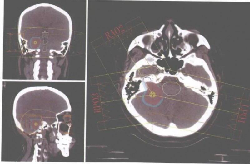 听神经瘤用质子刀做好吗,质子治疗听神经瘤病例参考