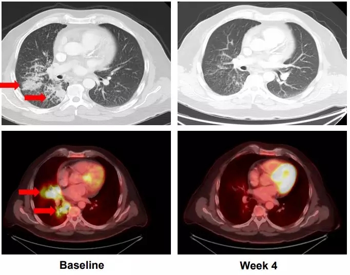 Retevmo治疗前后对比