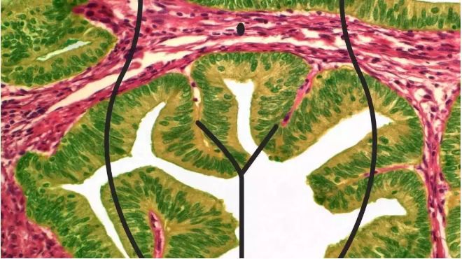 子宫癌怎么治,子宫癌怎么治疗,子宫癌怎么治疗比较好,子宫癌治疗,子宫癌的治疗方法,子宫颈癌怎么治疗,子宫癌的治疗