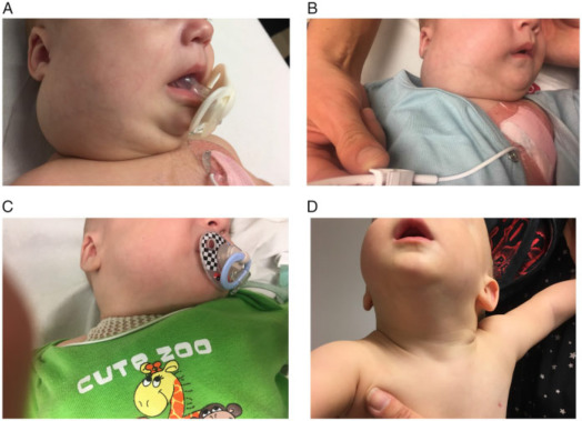 拉罗替尼临床试验治疗先天性婴儿纤维肉瘤成功案例