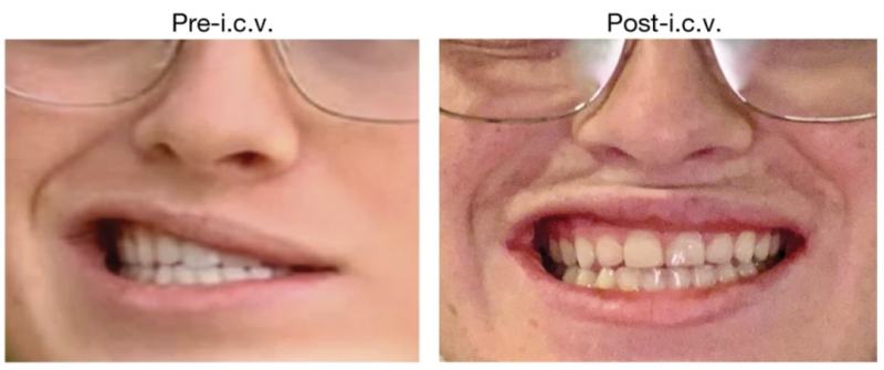 《Nature》重磅:CAR-T细胞疗法iv GD2-CAR-T治疗脑胶质瘤,肿瘤体积缩小27%