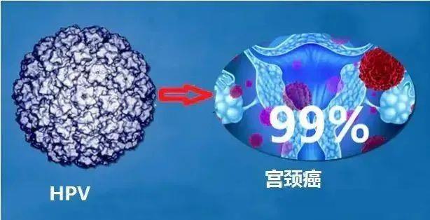 晚期宫颈癌抗癌成功案例,世界首例使用免疫细胞疗法治愈宫颈癌的病例