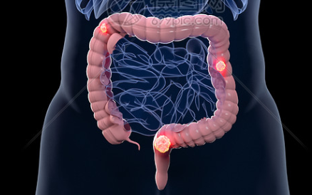 结直肠癌靶向药物,NTRK靶向药拉罗替尼成为抗癌新星
