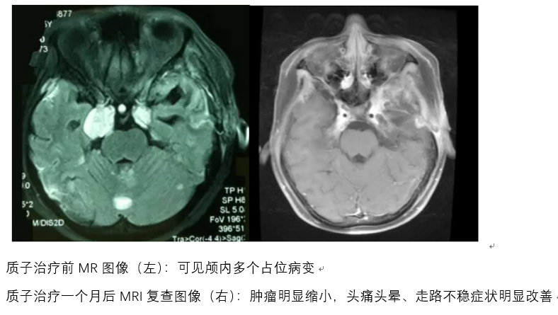 孩子不幸患了髓母细胞瘤怎么办？科普告诉你该怎么治
