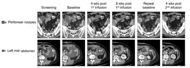CT041治疗晚期胃癌:肿瘤病灶及腹水均改善