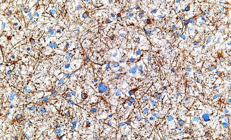 最新研究发现对抗脑胶质瘤的新策略