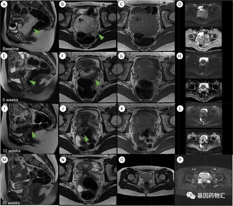 中国国家药品监督管理局(NMPA)授予NTRK/ROS1抑制剂恩曲替尼用于治疗NTRK融合阳性的儿童实体瘤优先审批资格
