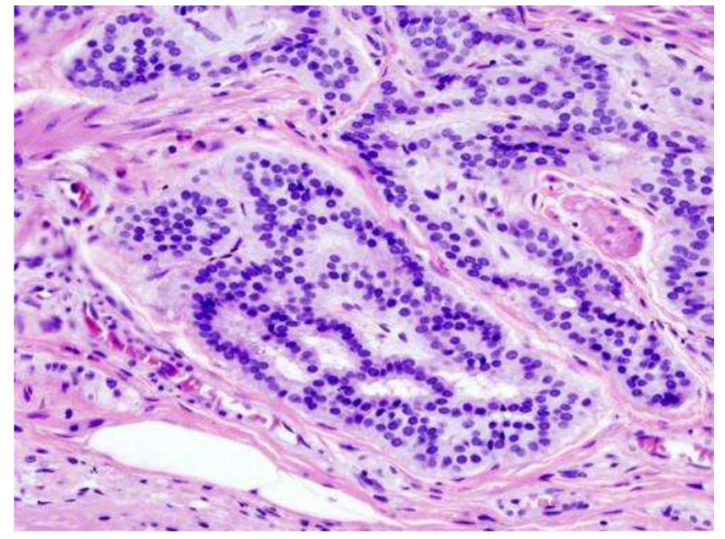 结直肠癌风险因素与遗传关系如此之大？