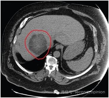 尖端放疗技术EDGE成功治疗巨大肝肿瘤脑转移患者