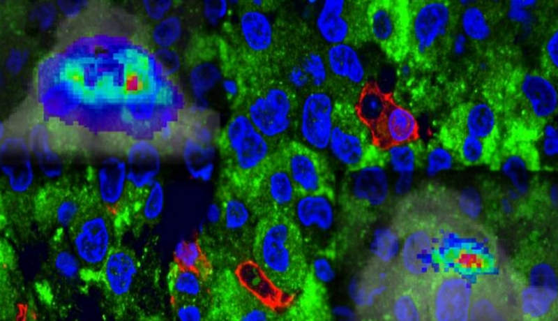 科学家最新发现！脑瘤治疗新靶点问世