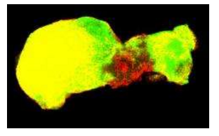神经胶质瘤抗血管生成易耐药 耐药机制终于被发现