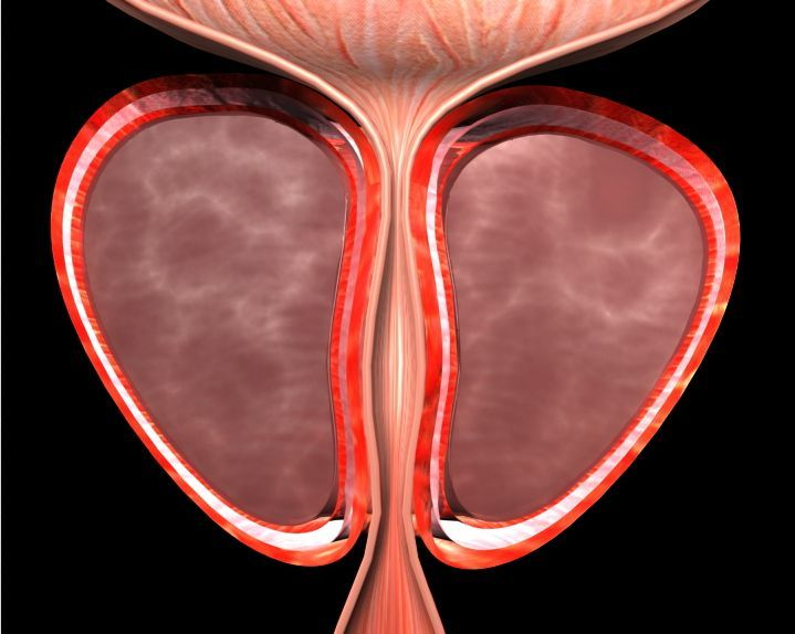 有了它 前列腺癌患者就知道是继续监测还是抓紧治疗了