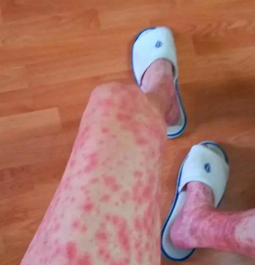 与癌相争，永不放弃！