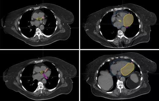 乳腺癌保乳术后放疗,左侧乳腺癌保乳术后质子治疗和传统光子放疗对比