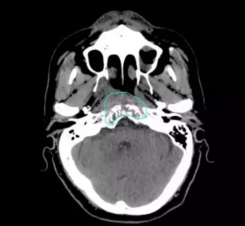 治疗1个月后复查,肿瘤明显缩小