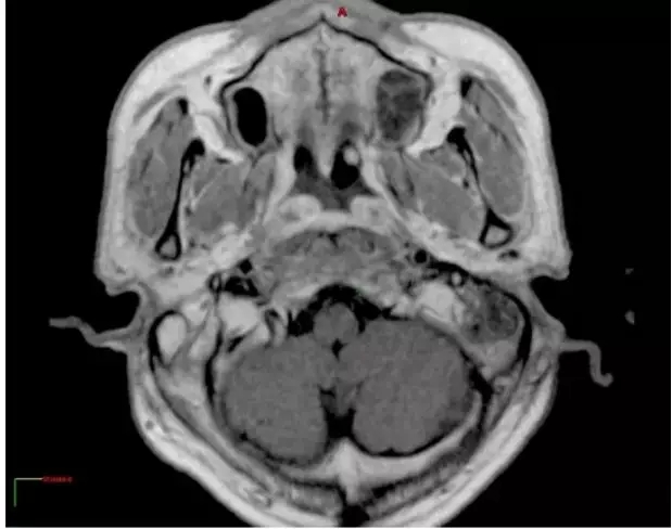 质子治疗7个月后MR图像,肿瘤缩小70%