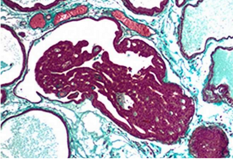 男性患前列腺癌居然有胎儿时期母亲的饮食习惯有关系！！