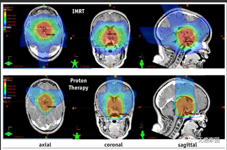 质子治疗颅咽管瘤