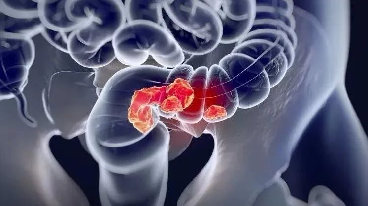 直肠癌放疗,直肠癌放疗适应症有哪些,直肠癌术前/术后放疗靶区勾画共识