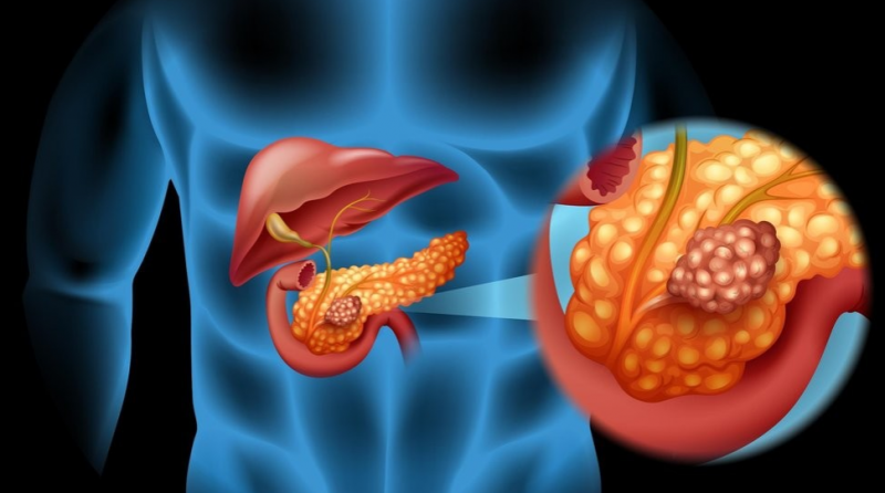 胰腺癌治疗没你想得那么简单！分内分泌型和外分泌型两类，药物选择完全不同！