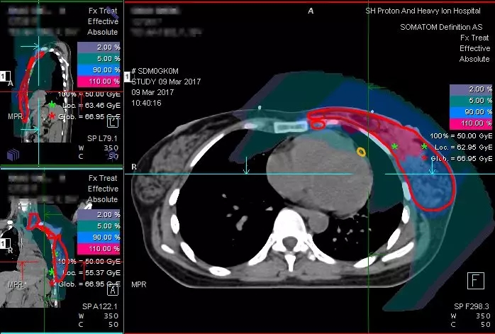 质子重离子治疗乳腺癌,乳腺癌质子重离子治疗成功案例